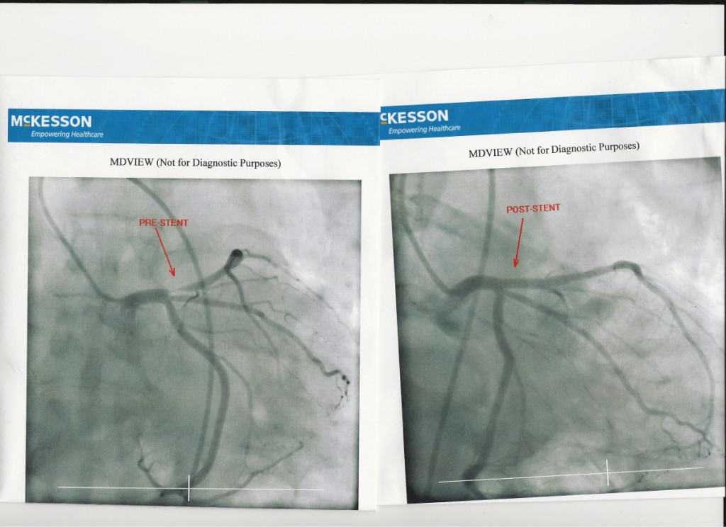 The Lord is My Shepherd - Before and After pictures of the stent